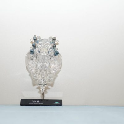 Vitalª Spinal Fixation System -  SAC-L4