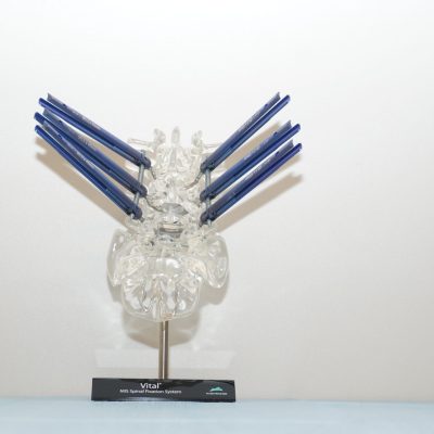 Vitalª MIS Screw System -  SAC-L2